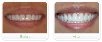 Smile Gallery Las Vegas - Invisalign 23