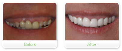 Smile Gallery Las Vegas - Upper Reconstruction 24