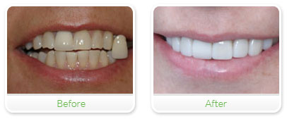 Smile Gallery Las Vegas - Upper Veneers 25