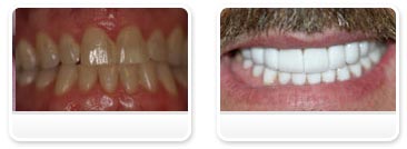 Dentist Las Vegas - Before and after 08