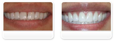 Dentist Las Vegas - Before and after 23