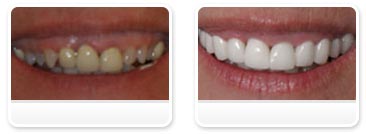 Dentist Las Vegas - Before and after 24