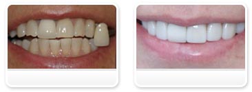 Dentist Las Vegas - Before and after 25