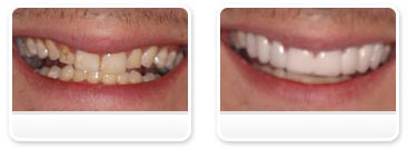 Dentist Las Vegas - Before and after 26