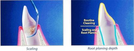 Dental Practice Las Vegas - Scaling and Root Planning
