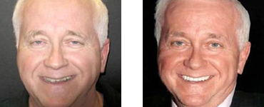 Teeth Whitening Before and after 01