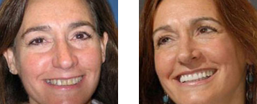 Teeth Whitening Before and after 02
