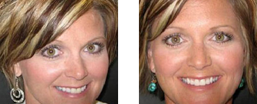 Teeth Whitening Before and after 03