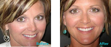 Before After Teeth Whitening