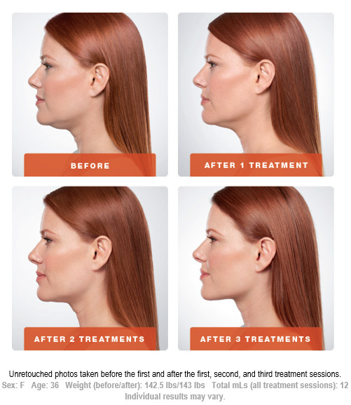 Before After Kybella Treatment Session