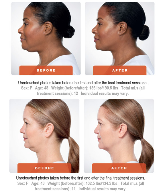 Kybella Before After