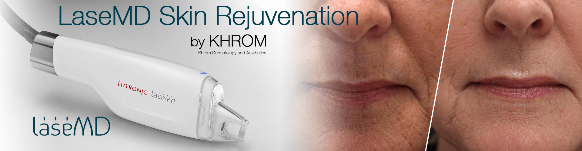 LaseMD Skin Rejuvenation By Khrom