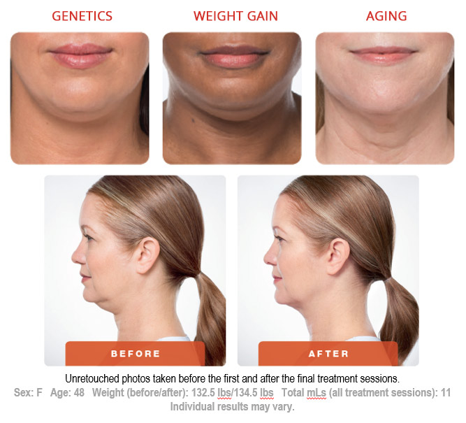 Kybella Before and After Kybella Before and After