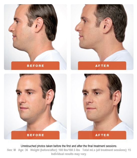 How does KYBELLA® work , Before After How does KYBELLA® work , Before After