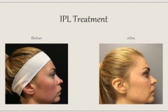Redness and Rosacea Treatment Before After Case 02