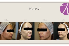 Chemical Peels and Microdermabrasion Before After Case 01