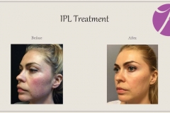 Redness and Rosacea Treatment Before After Case 01