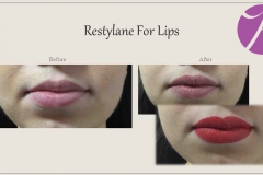 Lip Treatment Before After Case 03