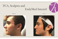 Acne Scars Treatment Before After Case 01