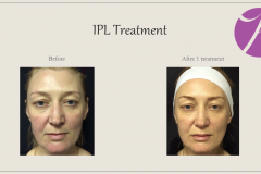 Redness and Rosacea Treatment Before After Case 03