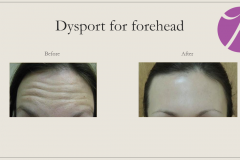Neuromodulators Before After Case 03