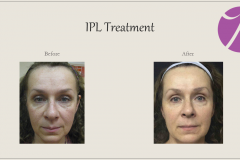 Pigmentation Treatment Before After Case 04