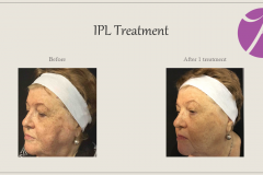 Pigmentation Treatment Before After Case 03