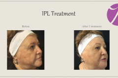 Pigmentation Treatment Before After Case 02