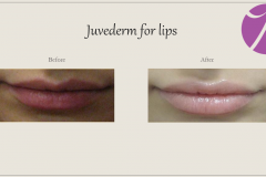 Lip Treatment Before After Case 02