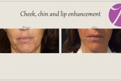 Cheeks, Nasolabial folds and Chin Treatment Before After Case 07