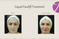 Sculptra for Rejuvenation Before After Case 01