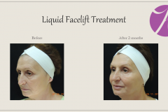 Sculptra for Rejuvenation Before After Case 02