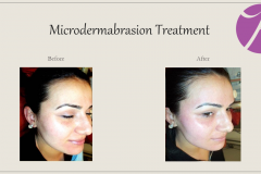 Chemical Peels and Microdermabrasion Before After Case 10
