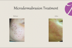 Chemical Peels and Microdermabrasion Before After Case 09
