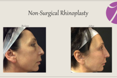 Non-Surgical Rhinoplasty Before After Case 03