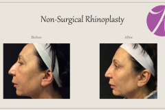 Non-Surgical Rhinoplasty Before After Case 02