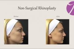 Non-Surgical Rhinoplasty Before After Case 04