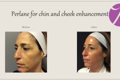 Cheeks, Nasolabial folds and Chin Treatment Before After Case 04