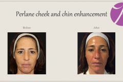 Cheeks, Nasolabial folds and Chin Treatment Before After Case 03
