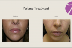 Cheeks, Nasolabial folds and Chin Treatment Before After Case 06