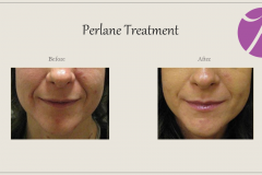 Cheeks, Nasolabial folds and Chin Treatment Before After Case 05