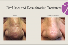Skin Resurfacing and Rejuvenation Before After Case 12