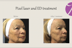 Skin Resurfacing and Rejuvenation Before After Case 11