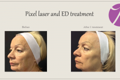 Skin Resurfacing and Rejuvenation Before After Case 10