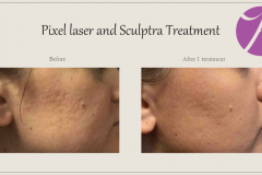 Acne Scars Treatment Before After Case 02