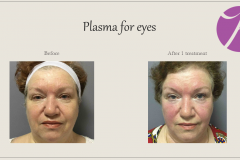 Skin Resurfacing and Rejuvenation Before After Case 03