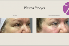 Skin Resurfacing and Rejuvenation Before After Case 02