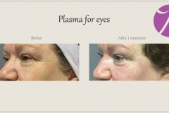 Skin Resurfacing and Rejuvenation Before After Case 01