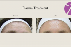 Skin Resurfacing and Rejuvenation Before After Case 09