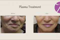 Skin Resurfacing and Rejuvenation Before After Case 08